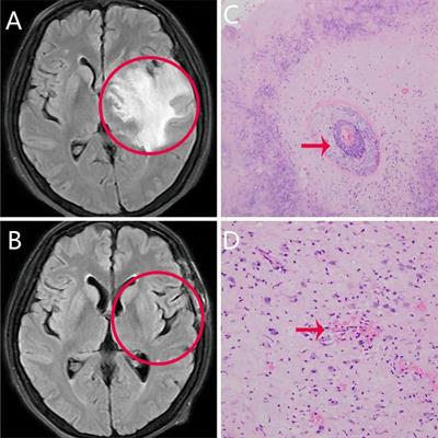 Case report: intracranial lesions in a patient with anxiety and depression: tumor recurrence or radiation encephalopathy?